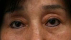 Eyelid Ptosis Surgery, After