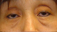 Eyelid Ptosis Surgery, Before