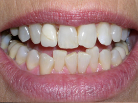 Crooked and in need of two years of braces 