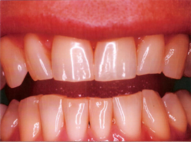 Worn and old looking teeth that are yellow