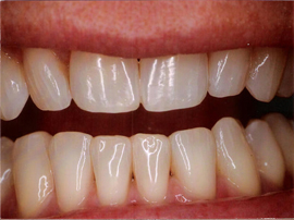Bleaching and re-contouring gives a youthful appearance!