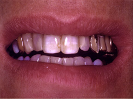 Worn out metal dental work and stained teeth