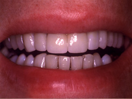 A new beautiful smile all metal - free!!
