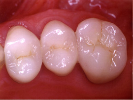 Strong, non-metal crowns . . . gorgeous replacement 01