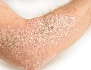 Acne treatments Medical and surgical
