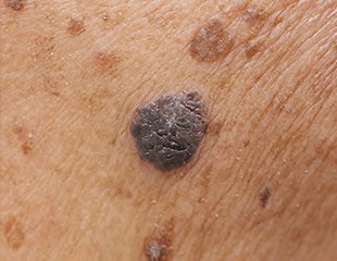 Acne treatments Medical and surgical