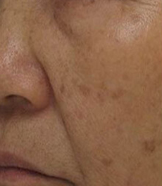 Silkpeel Before case 02