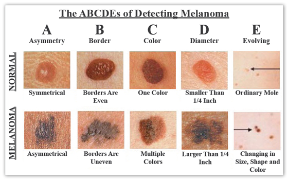 Skin Cancer- Skin Cancers ABCDEs Of Detecting Malanoma