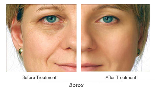 Botox Before After Case 01