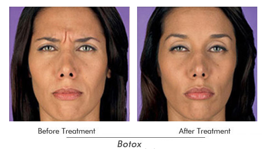 Botox Before After Case 02
