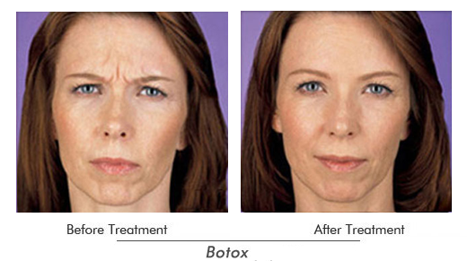 Botox Before After Case 03
