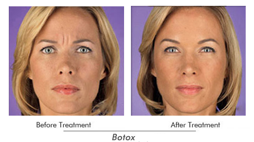 Botox Before After Case 04