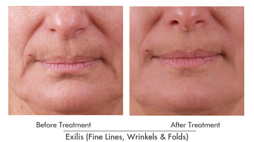 Exilis Before After Case 01