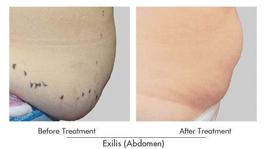 Exilis Before After Case 13