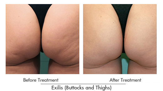 Exilis Before After Case 17