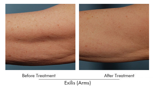 Exilis Before After Case 19