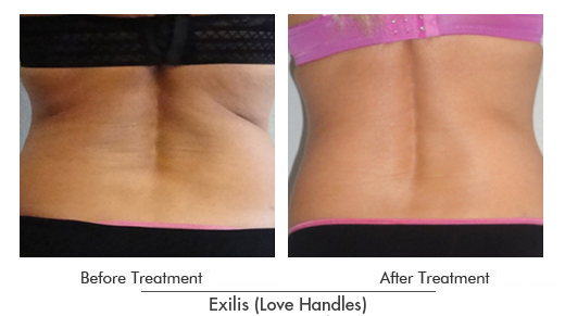 Exilis Before After Case 23