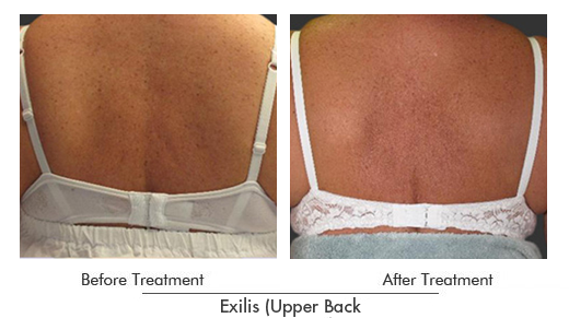 Exilis Before After Case 24