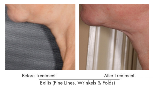 Exilis Before After Case 08