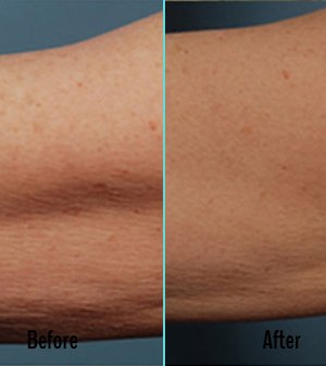 Exilis Before and After Case 15
