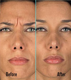 Botox Before and After Case 03