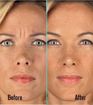 Botox Before and After Case 06