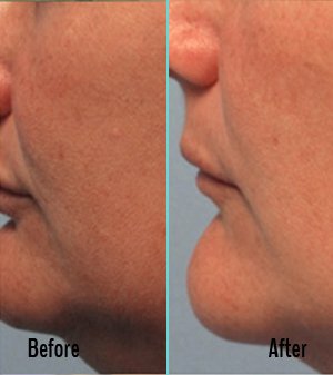 Exilis Before and After Case 25
