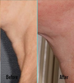 Exilis Before and After Case 30