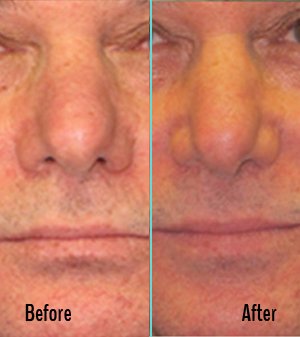 Exilis Before and After Case 31