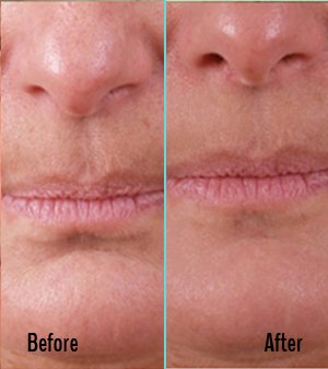 Exilis Before and After Case 32