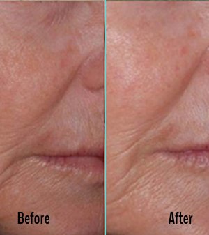 Exilis Before and After Case 33