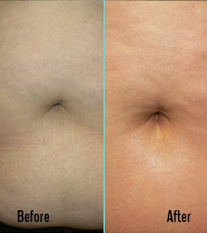 Exilis Before and After Case 04