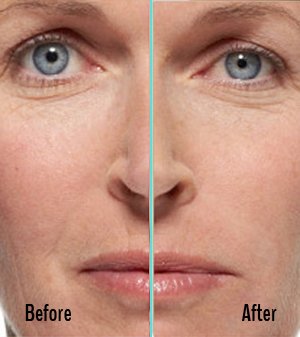 Radiesse Before and After Case 02