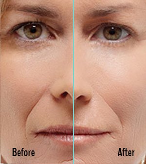 Radiesse Before and After Case 03