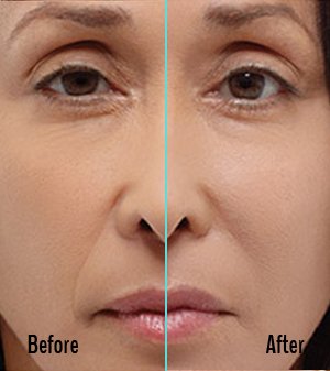 Radiesse Before and After Case 04