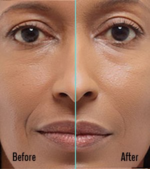 Radiesse Before and After Case 05