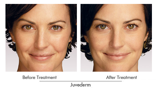 Juvéderm Before After Case 01