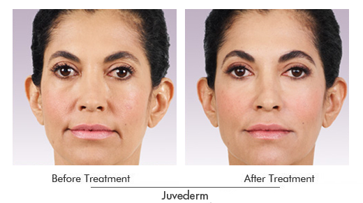 Juvéderm Before After Case 02