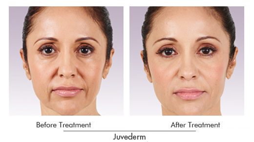 Juvéderm Before After Case 03