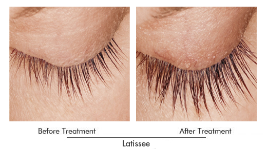 Latissee Before After Case 01