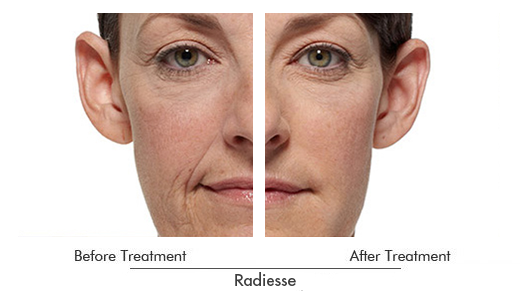 Radiesse Before After Case 01