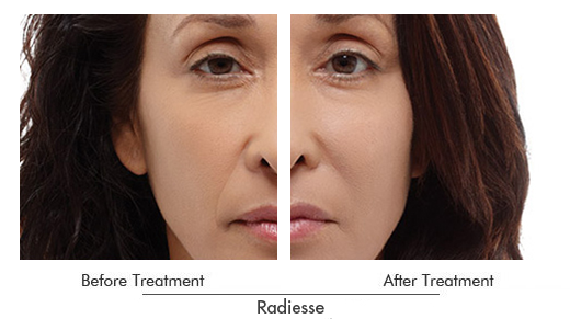 Radiesse Before After Case 02