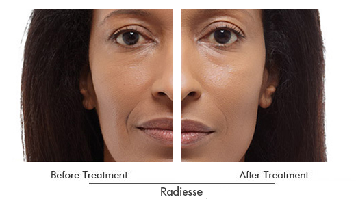 Radiesse Before After Case 03