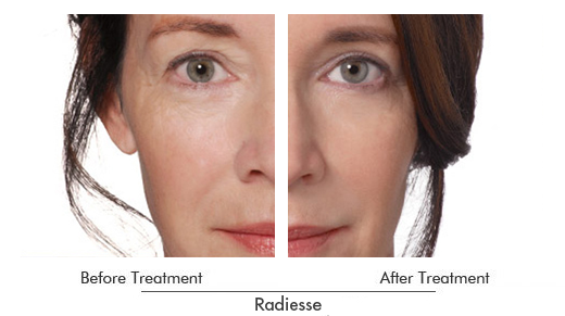 Radiesse Before After Case 04
