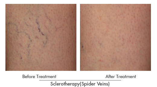 Sclerotherapy (Spider Veins) Before After Case 01