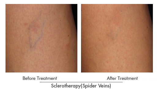 Sclerotherapy (Spider Veins) Before After Case 02