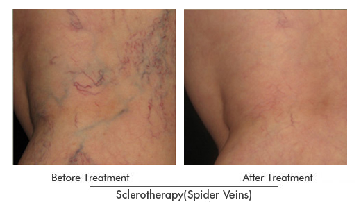 Sclerotherapy (Spider Veins) Before After Case 03