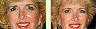 <?php echo $pk;?> - Before After 02