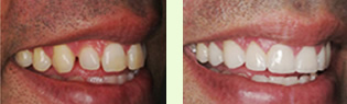 <?php echo $pk;?> - Before After 01