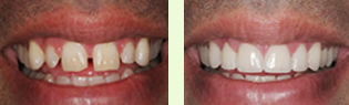 <?php echo $pk;?> - Before After 02